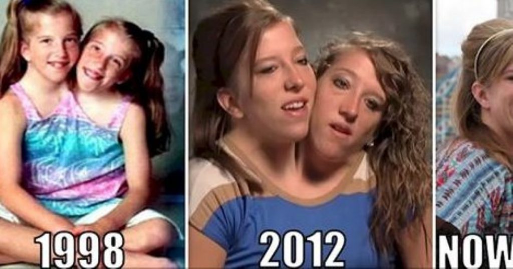 Conjoined twins Abby and Brittany Hensel reveal secrets of 