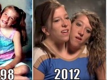 conjoined-twins-abby-and-brittany-hensel-1